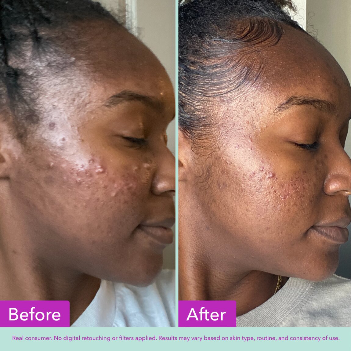 acne-foaming-cleanser-t1 zb_p.jpg