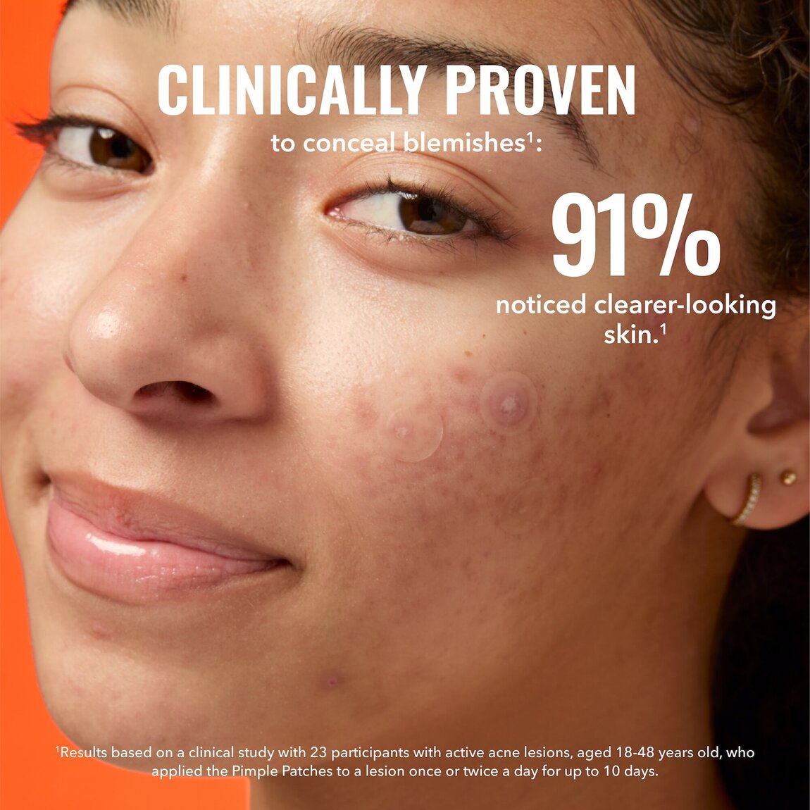 pimple-patches-h9 zb_p.jpg