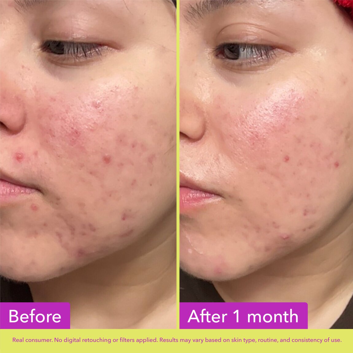 10-azelaic-acid-treatment-q3 zb_p.jpg